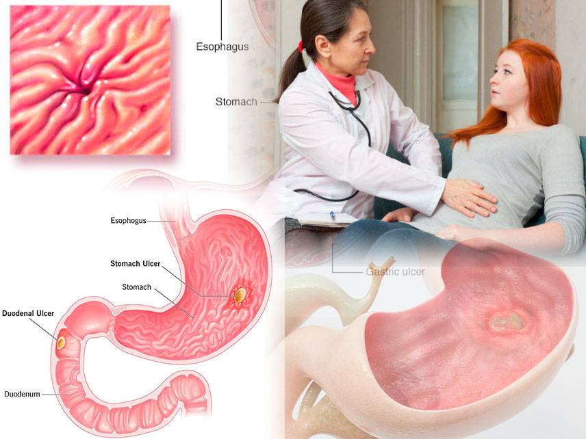 Peptic Ulcer Disease: signs and symptoms, causes, diagnosis, treatment.