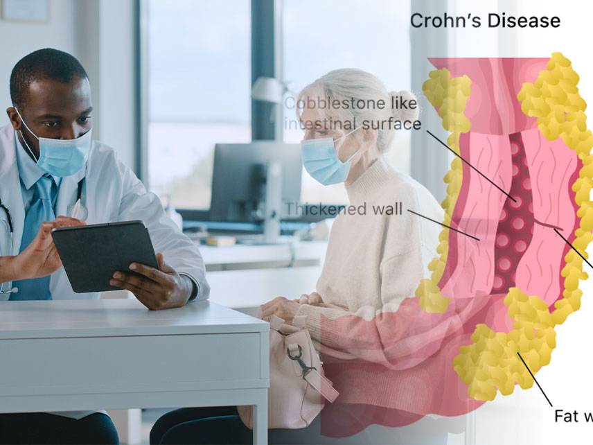 Qué es la enfermedad de Crohn: síntomas, causas, diagnóstico, tratamiento.