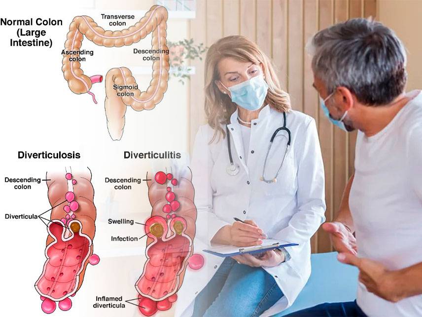 What is Diverticulitis: symptoms, diagnosis, treatment.